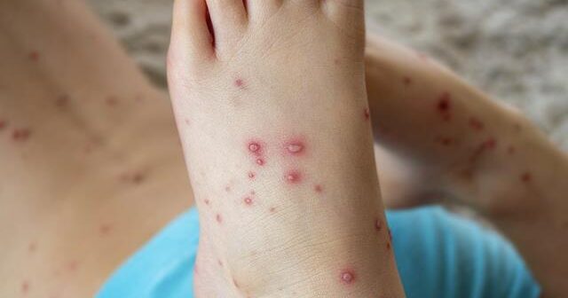Dünyada öldürücü virus yayılıb: Əlamətləri bunlardır