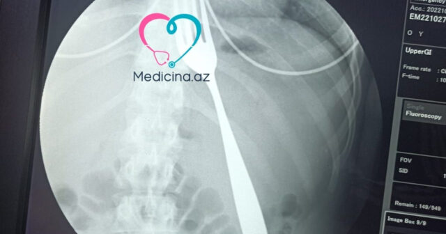 Azərbaycanda şok hadisə – 21 yaşlı qız çəngəl uddu