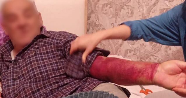 “Medical Plaza”da 4500 AZN alıb qan köçürdülər, qolu bu vəziyyətə düşdü