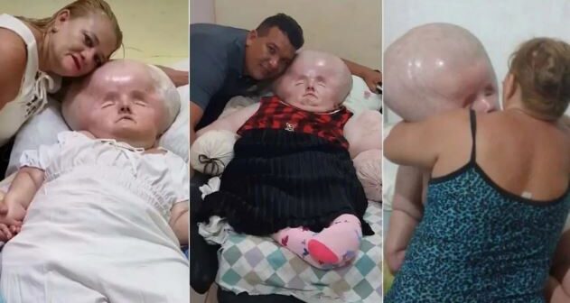Nadir xəstəliklə doğulan uşağın başı dayanmadan böyüyür – FOTO