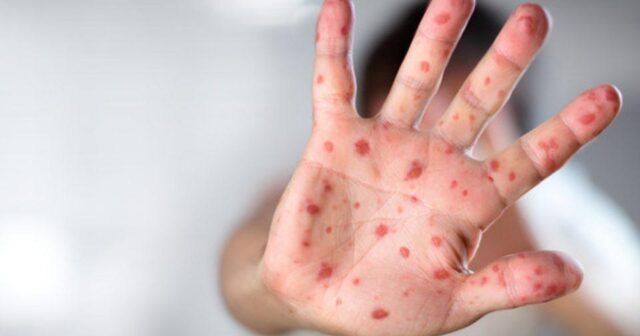 SOS: MƏKTƏBLƏRDƏ QIZILCA VƏ SUÇİÇƏYİ YAYILIB… PEDİATRDAN MƏSLƏHƏT