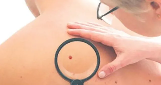 Dəri xərçəngi riskini azaldan 3 qida