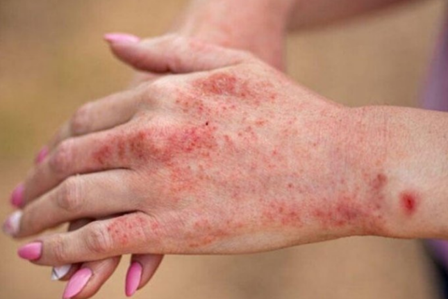 Dermatloq: Sızanaq xərçəng əlaməti ola bilər