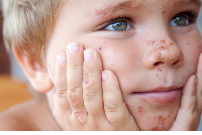 Valideynlərin DİQQƏTİNƏ! Uşaqlar arasında bu virus yayılıb…