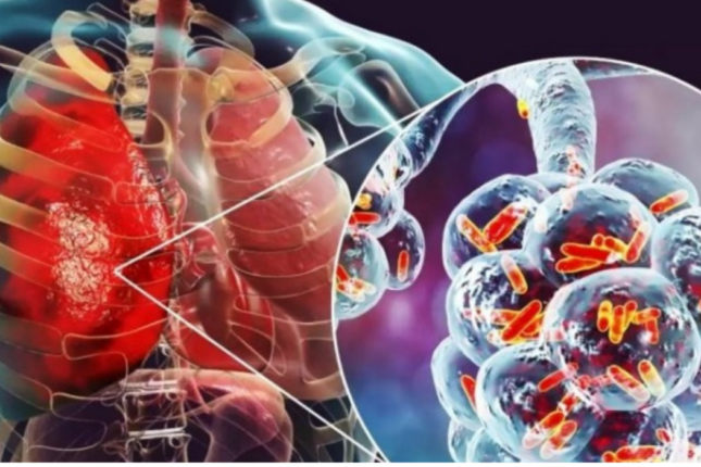 Azərbaycanda pnevmoniyaya yoluxan 400-dən çox şəxs ölüb