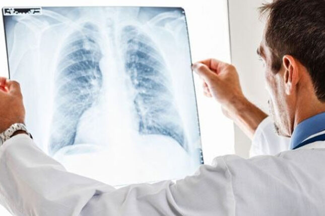 Azərbaycanda vərəm xəstələrinin sayı 6 mini ötdü