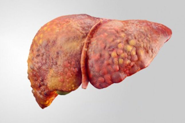 Qaraciyər yağlanmasının inkişafını dayandırmağın yolu