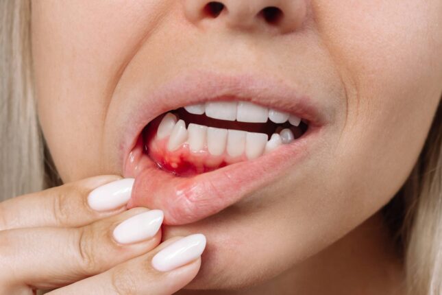 Diş və ağız xəstəlikləri  infarkta yol açırmış- Araşdırma