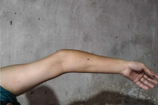 “Bu qolla nə işləyə, nə əlillik ala bilirəm…”