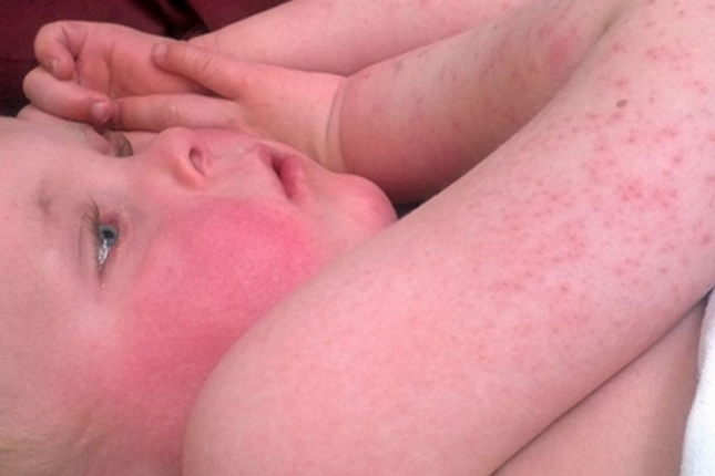 SOS! Bağça və məktəblərdə bu virus yayılıb…