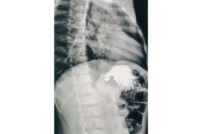 2 yaşlı uşaq kimyəvi maddə içdi: “Qida borusu və mədəsi…” – Video