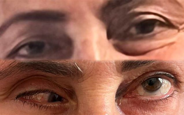 Bu klinika təzminat ödəyəcək – Burun düzəldəndə gözü zədələyib
