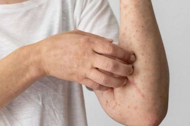 Qızılca və suçiçəyinə yoluxanların sayı açıqlandı – RƏSMİ