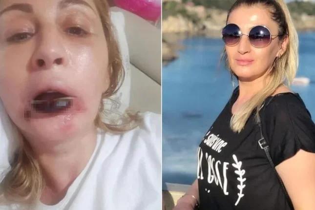 Antalyada gözəlləşmək istəyən qadını görün nə günə saldılar – FOTOLAR Antalyada gözəlləşmək istəyən qadını görün nə günə saldılar – FOTOLAR